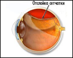 Ретинопатия, отслойка сетчатки, лечение отслойки сетчатки, отслойка сетчатки лечение, лекарства от отслойки сетчатки, средства от отслойки сетчатки, ретинопатия лечение, лечение ретинопатии, лекарства от ретинопатии, средства от ретинопатии, частичная отслойка сетчатки, неполное отслоение сетчатки, чем лечить ретинопатию, чем лечить отслойку сетчатки, отслойка сетчатки лечение народное, отслойка сетчатки лечение травами, отслойка сетчатки лечение иглами, отслойка сетчатки лечение лазером. Киев